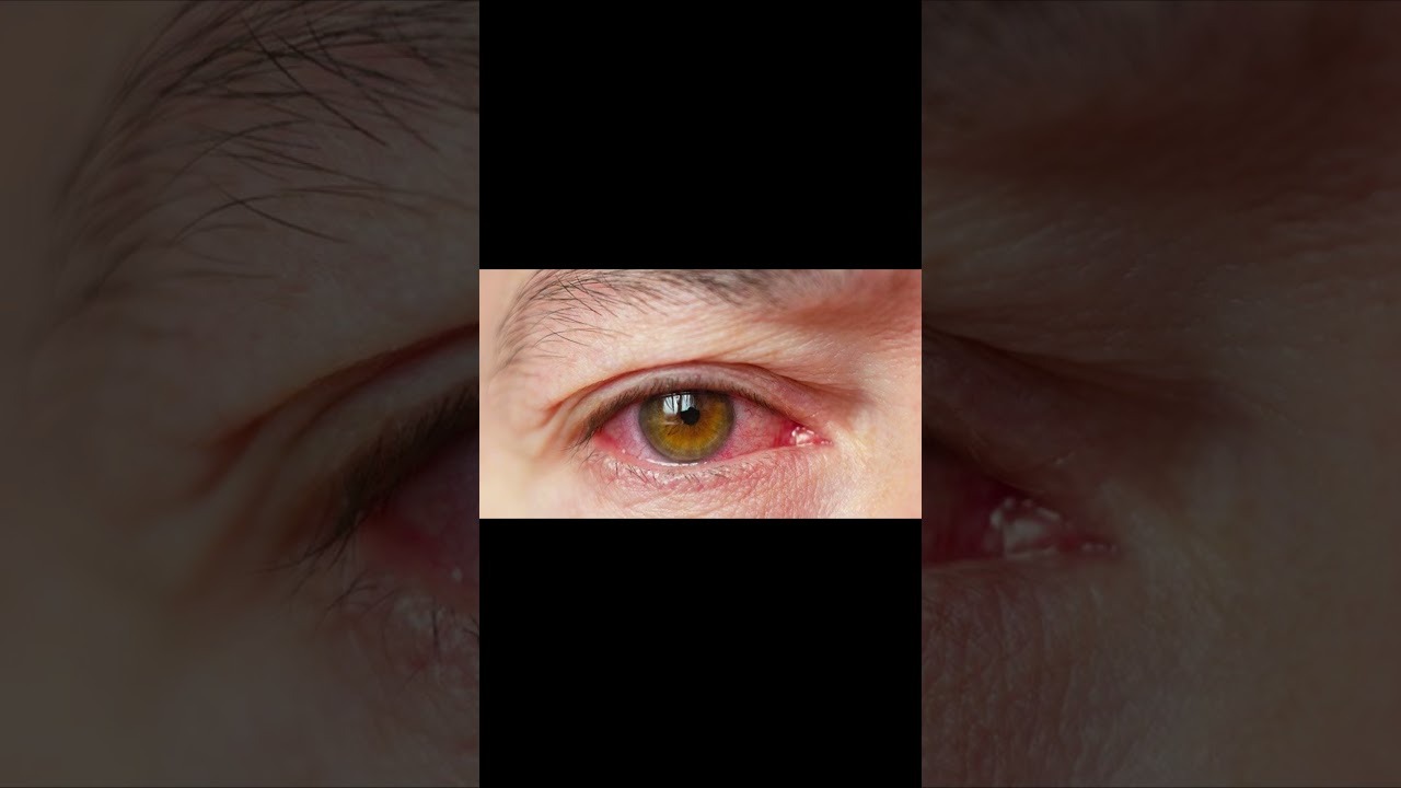 EYEFORTIN REVIEWS - (🧐👀 UNBELIEVABLE RESULTS 😳✅) - Eyefortin Vision Supplement - Does Eye Fortin Work?